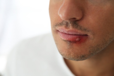 Man with herpes on lip against light background, closeup. Space for text