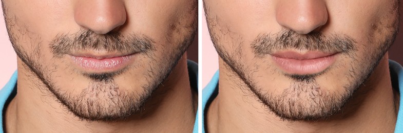 Image of Collage with photos of man before and after lips augmentation, closeup. Banner design