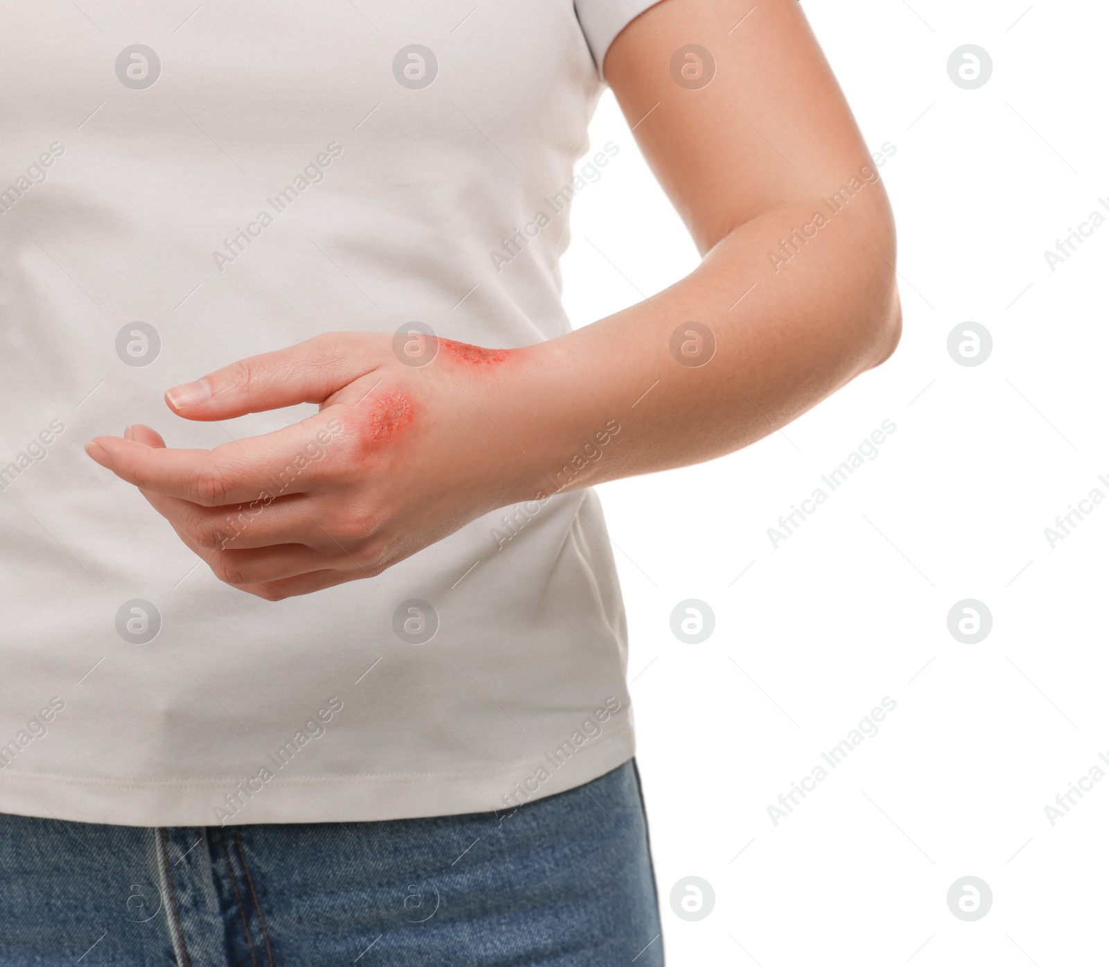 Photo of Woman with burned hand on white background, closeup