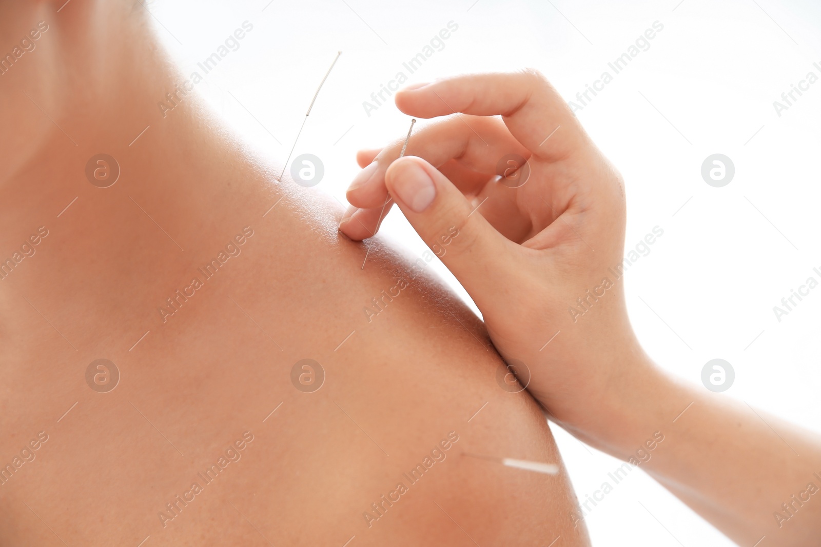 Photo of Young woman undergoing acupuncture treatment in salon, closeup