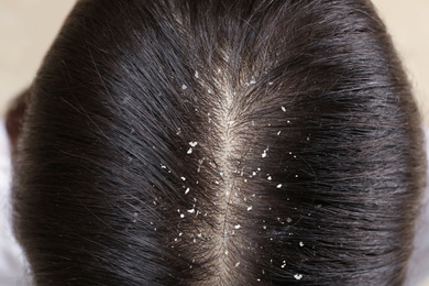 Image of Woman with dandruff in her dark hair, closeup view