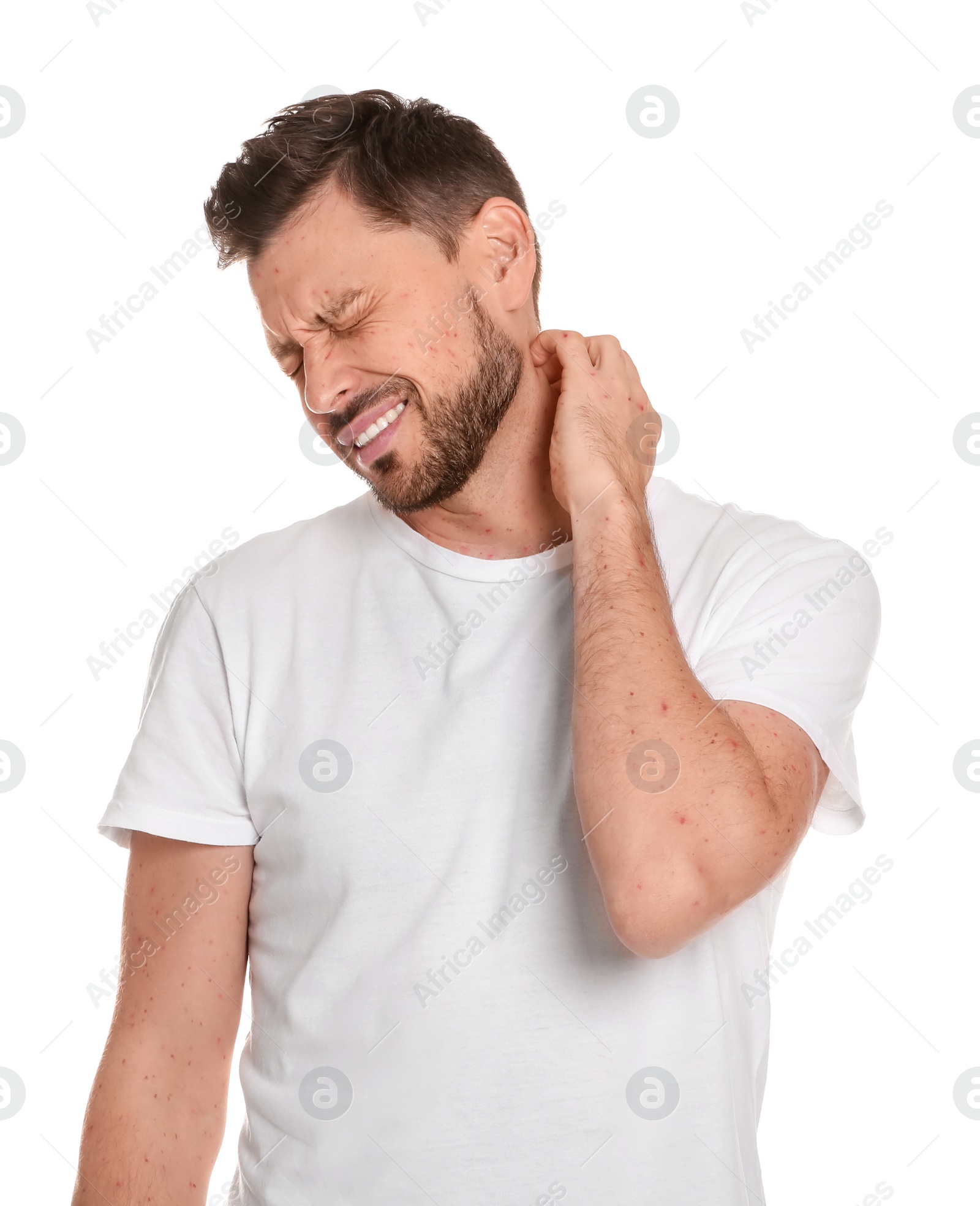 Photo of Man with rash suffering from monkeypox virus on white background