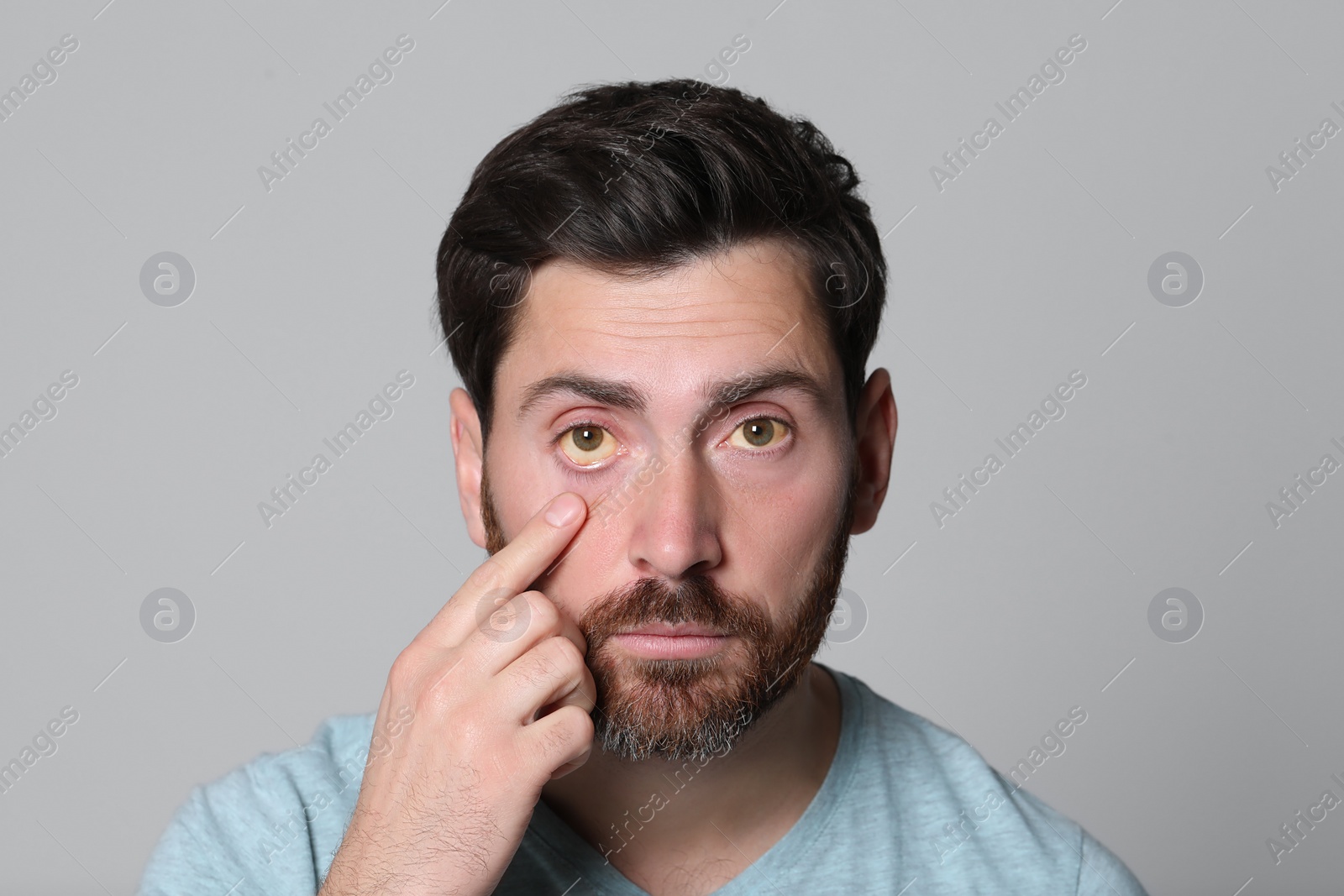 Photo of Man with yellow eyes on grey background. Symptom of hepatitis