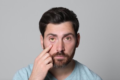 Photo of Man with yellow eyes on grey background. Symptom of hepatitis