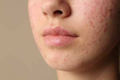 Photo of Teenage girl with acne problem on beige background, closeup