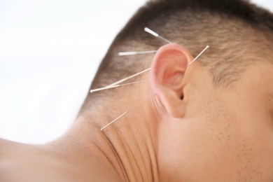 Photo of Young man undergoing acupuncture treatment in salon, closeup