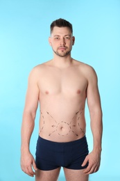 Photo of Man with marks on belly for cosmetic surgery operation against blue background