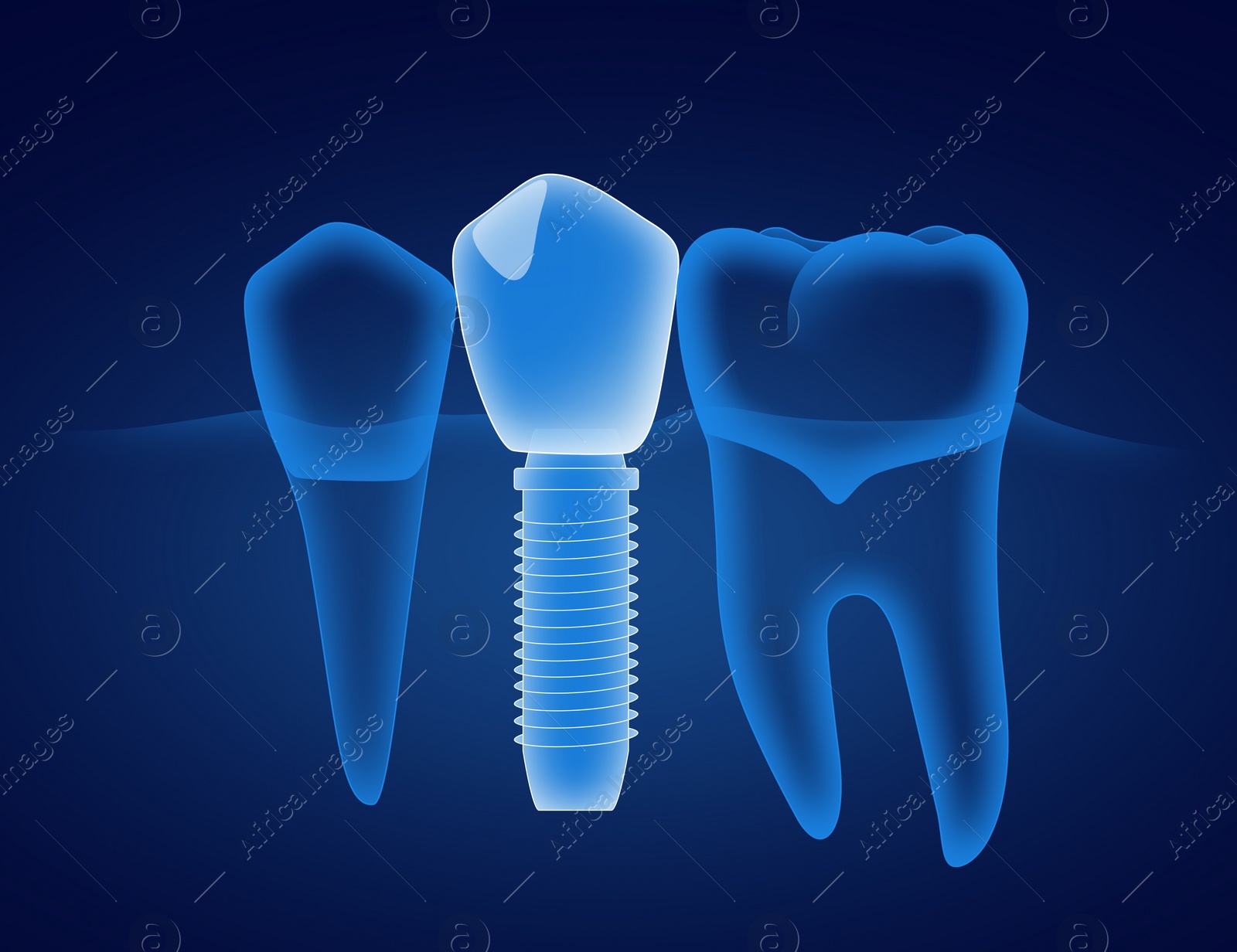 Illustration of  teeth and dental implant on dark blue background