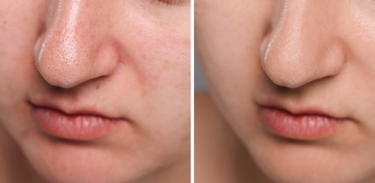 Image of Blackhead treatment, before and after. Collage with photos of woman, closeup view