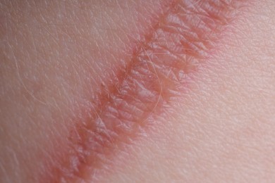Photo of Texture of skin with scar as background, macro view
