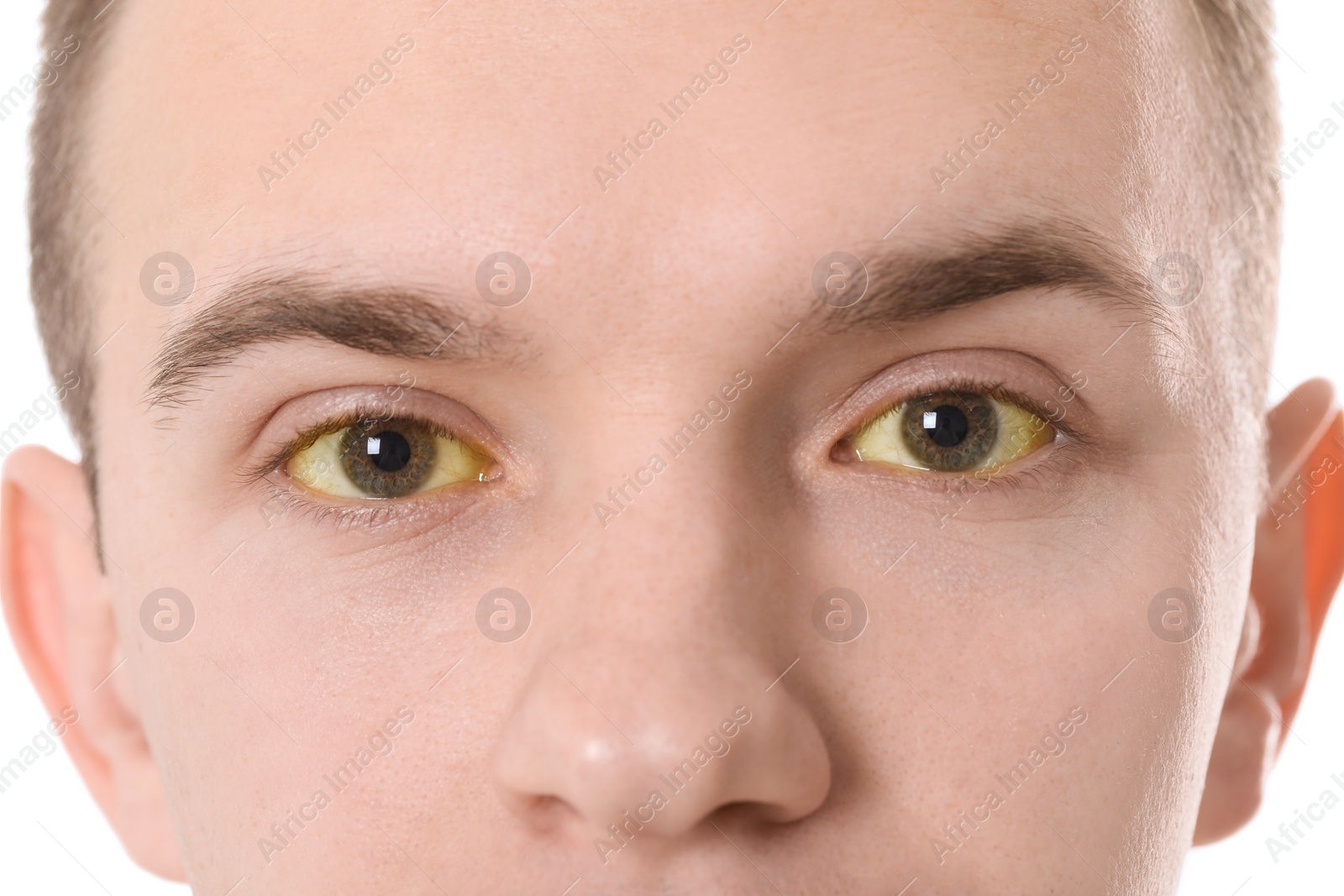 Photo of Man with yellow eyes on white background, closeup. Symptom of hepatitis