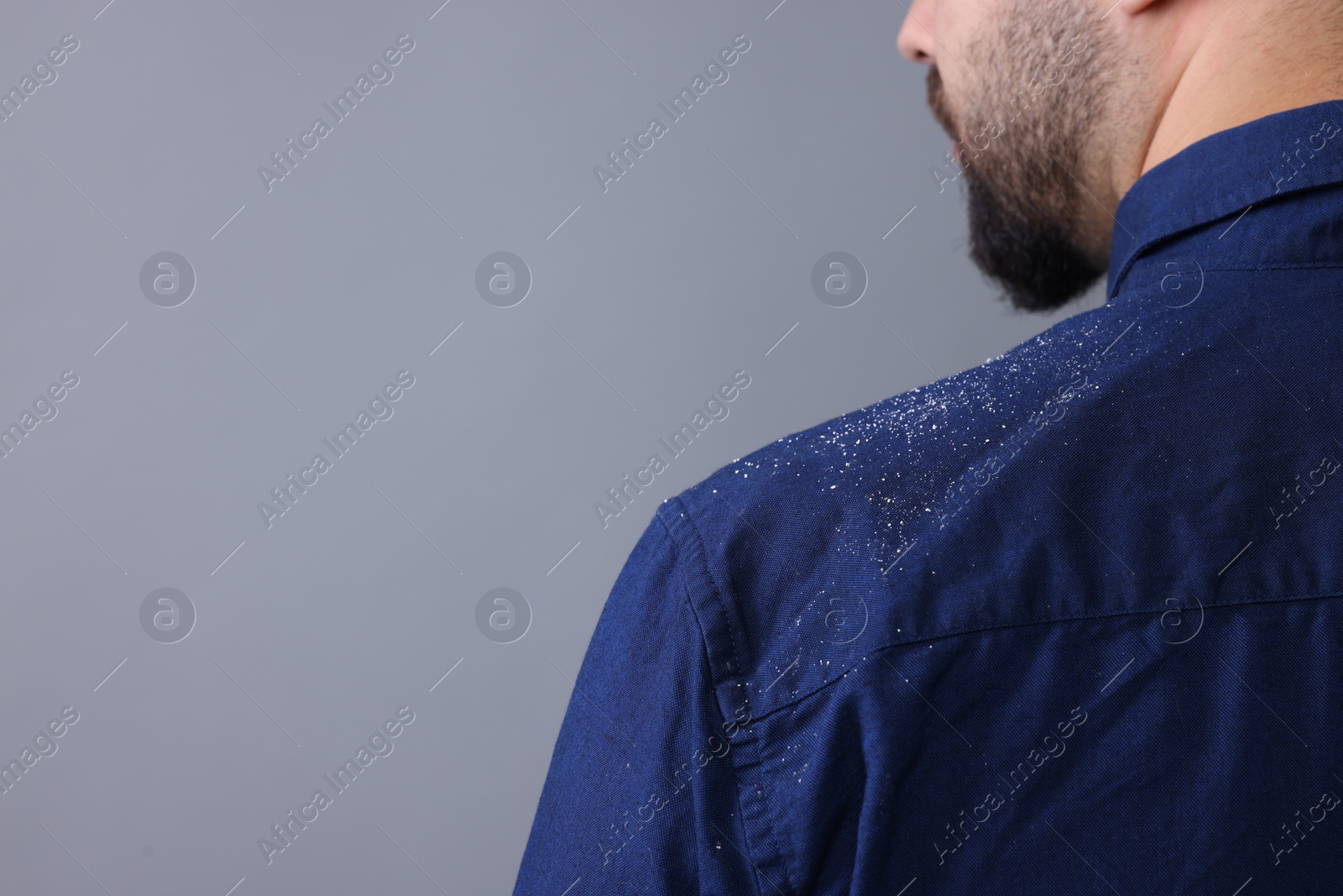 Photo of Man with dandruff on his shirt against grey background, closeup. Space for text
