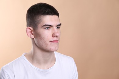 Photo of Young man with acne problem on beige background. Space for text
