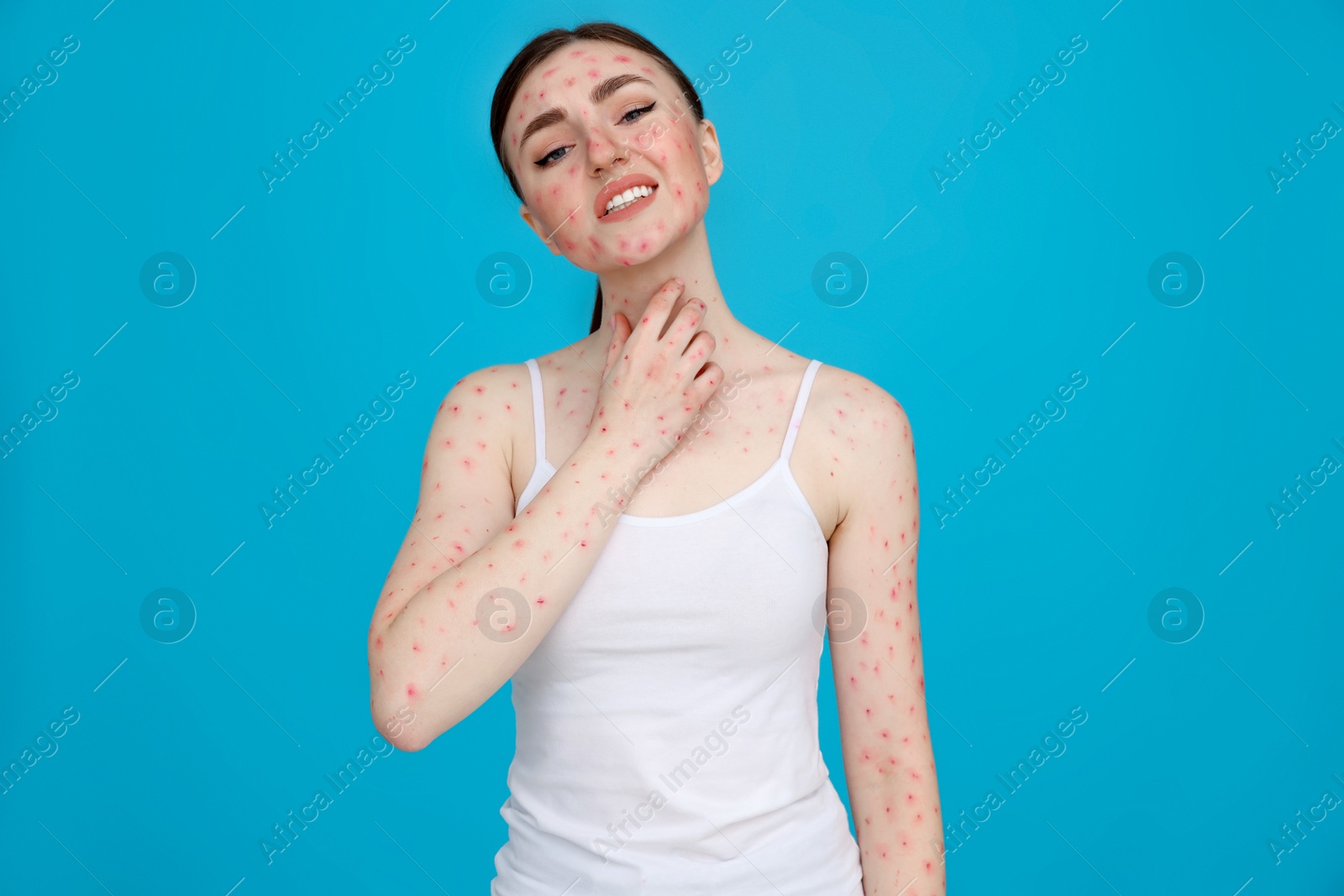 Photo of Woman with rash suffering from monkeypox virus on light blue background