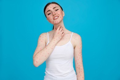 Photo of Woman with rash suffering from monkeypox virus on light blue background