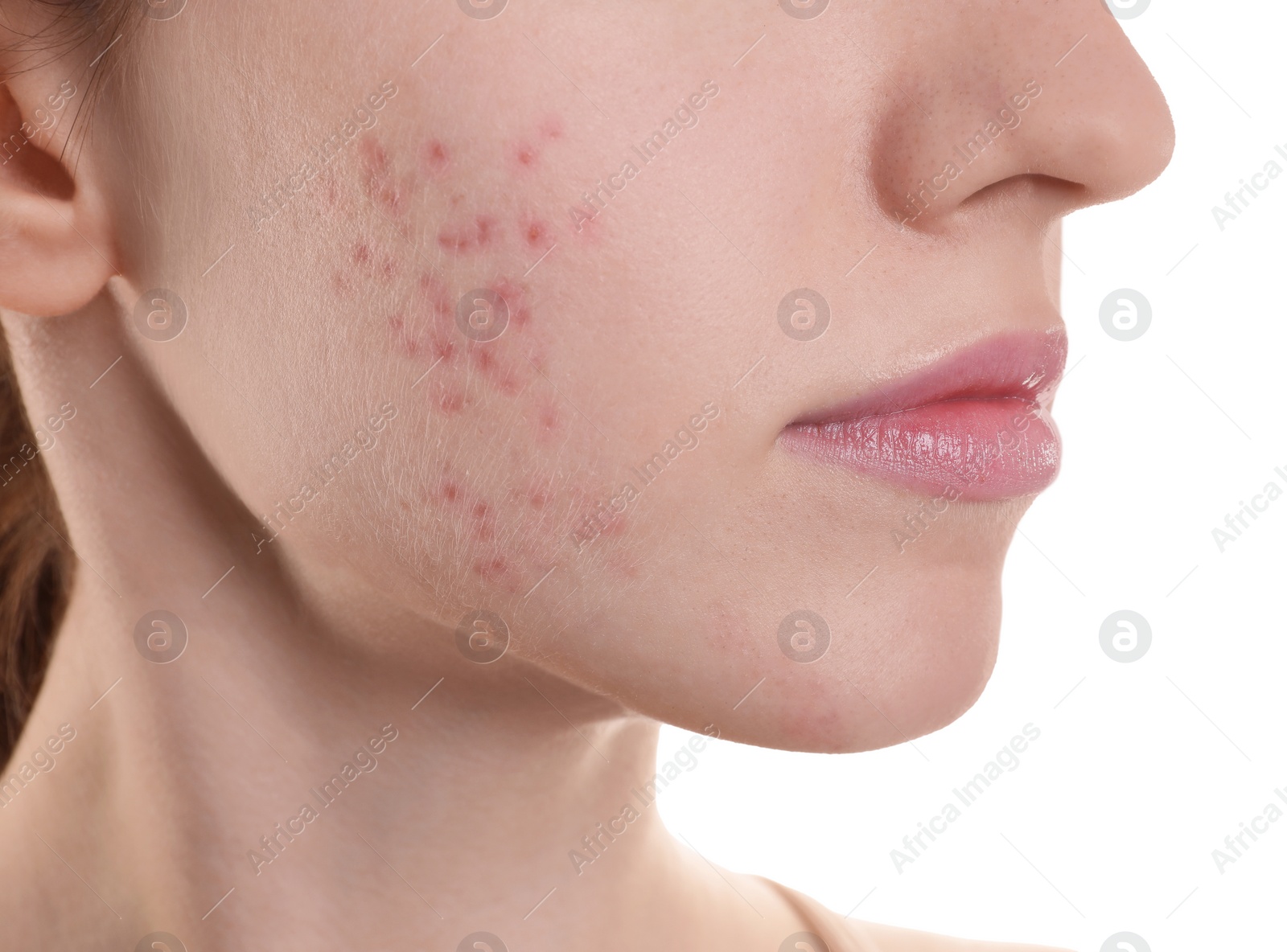 Photo of Young woman with acne problem on white background, closeup