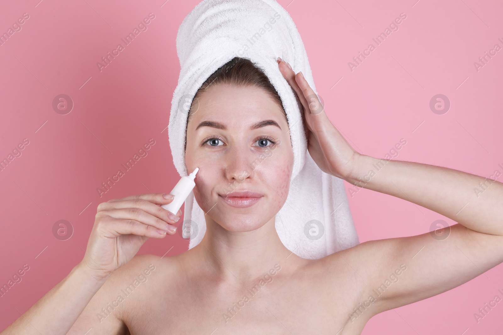 Photo of Young woman with acne problem applying cosmetic product onto her skin on pink background