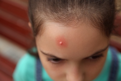 Photo of Girl with insect bite on forehead outdoors, closeup