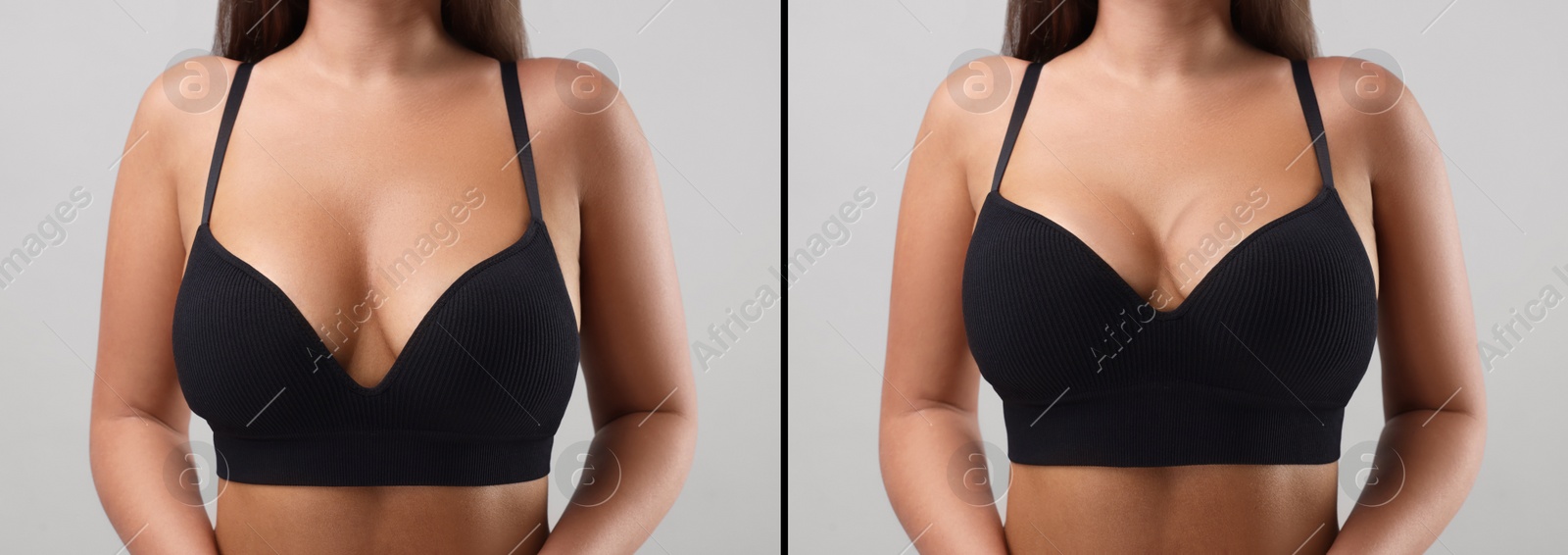 Image of Collage with photos of woman before and after breast-lift surgery on light grey background, closeup