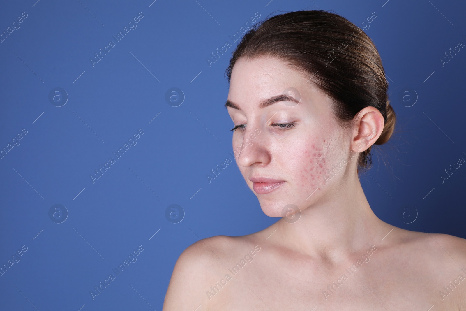 Photo of Young woman with acne problem on blue background. Space for text