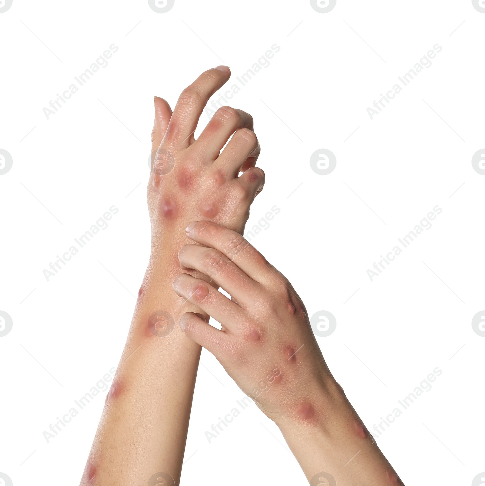 Photo of Woman with rash suffering from monkeypox virus on white background, closeup