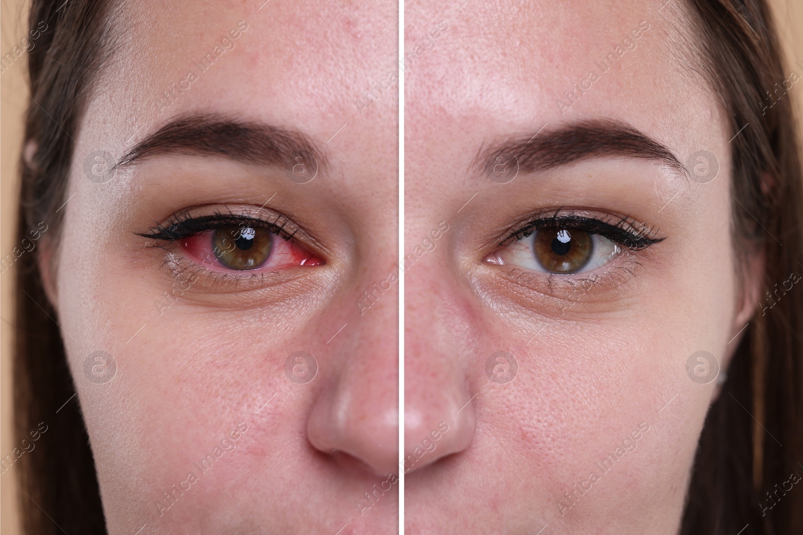 Image of Before and after conjunctivitis treatment. Photos of woman with red and healthy eyes, collage