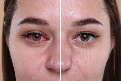 Before and after conjunctivitis treatment. Photos of woman with red and healthy eyes, collage