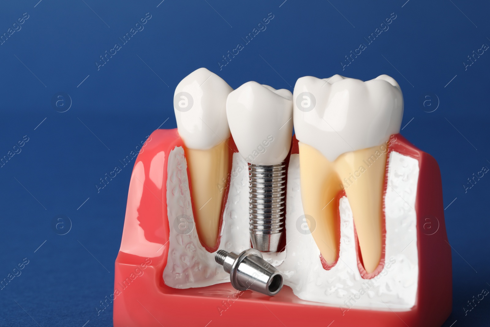 Photo of Educational model of gum with dental implant between teeth on blue background, closeup