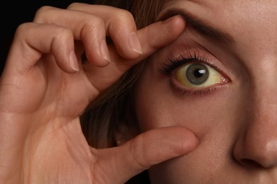 Photo of Woman checking her health condition, closeup. Yellow eyes as symptom of problems with liver
