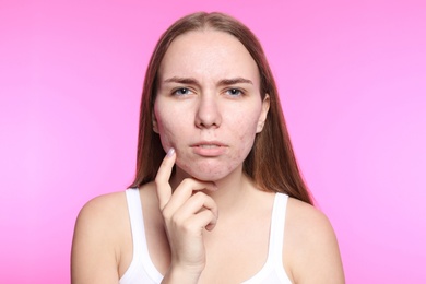 Young woman with acne problem on color background