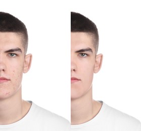 Image of Acne problem. Young man before and after treatment on white background, collage of photos