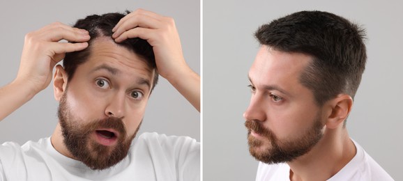 Image of Man showing hair before and after dandruff treatment on grey background, collage