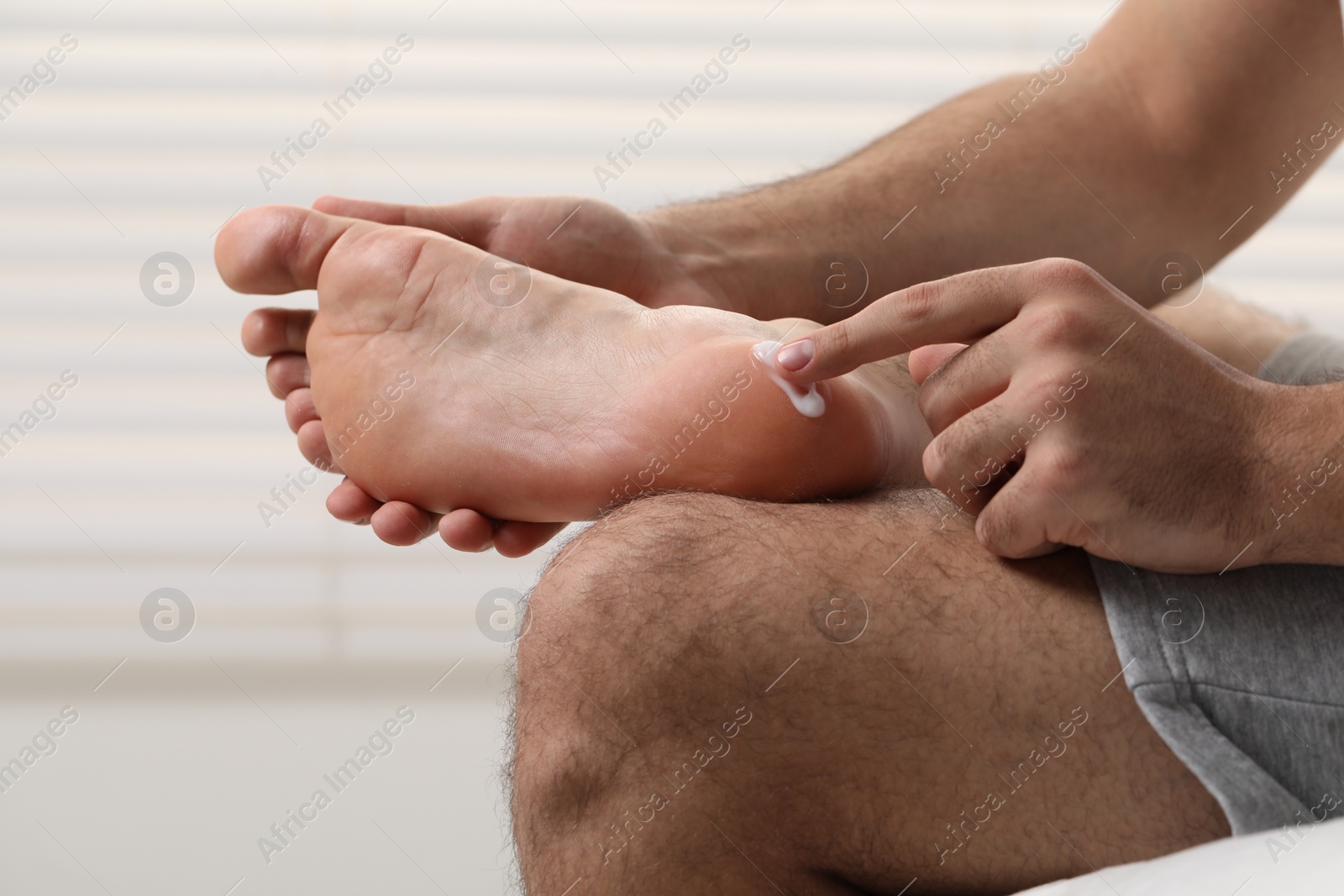 Photo of Man with dry skin applying cream onto his foot on light background, closeup