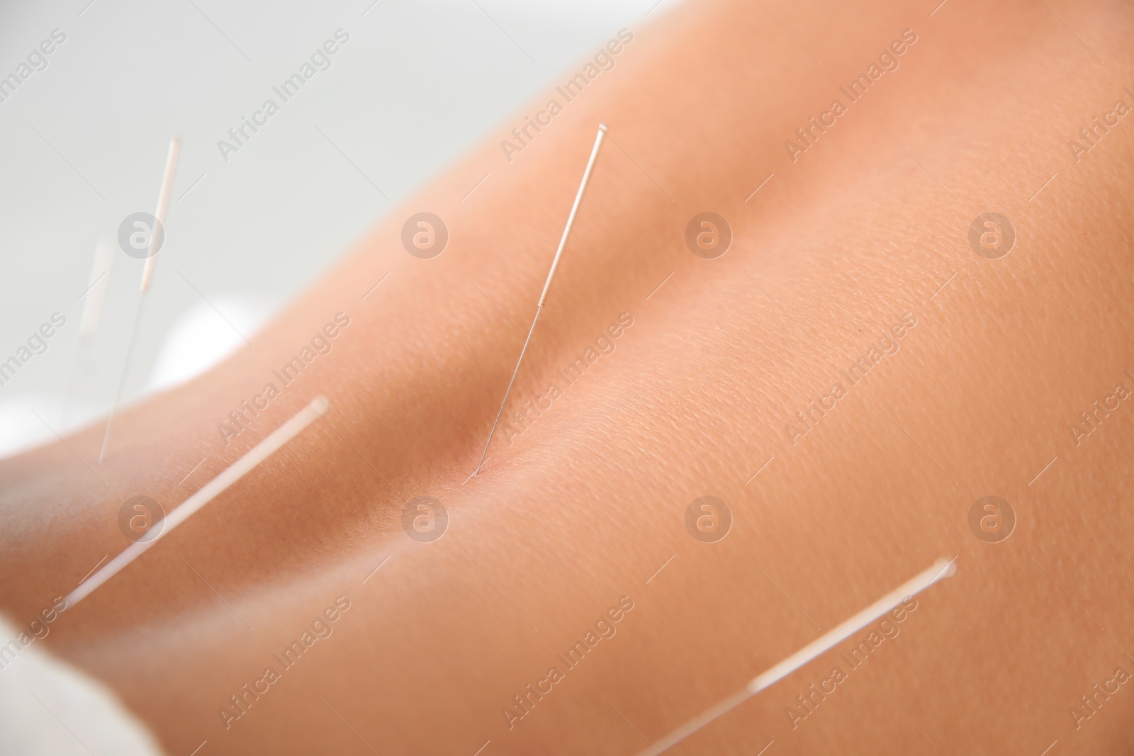 Photo of Young man undergoing acupuncture treatment in salon, closeup