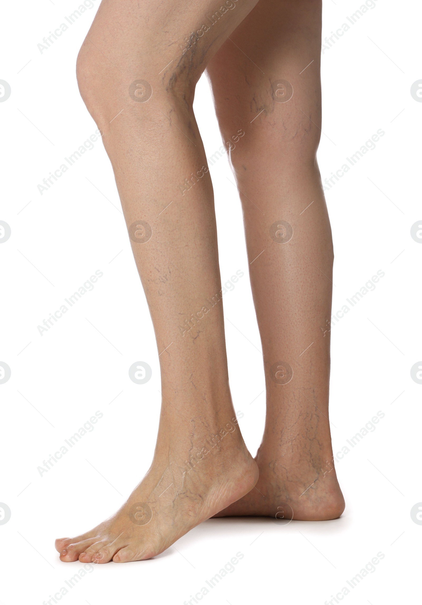 Photo of Closeup view of woman with varicose veins on white background