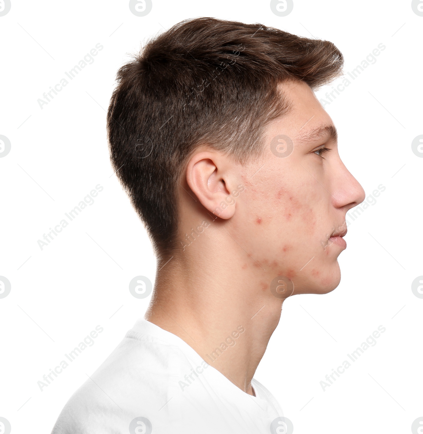 Photo of Teen guy with acne problem on white background