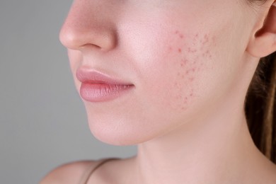 Photo of Young woman with acne problem on light grey background, closeup