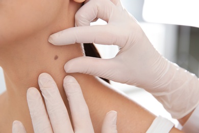 Dermatologist examining patient's birthmark in clinic, closeup