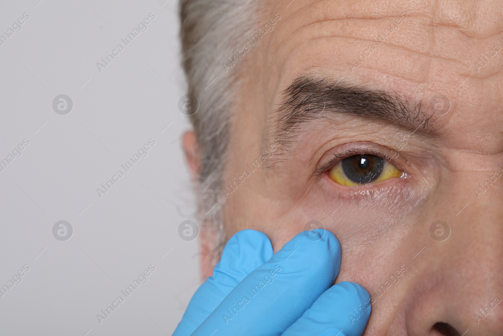 Photo of Doctor checking man with yellow eyes on light background, closeup. Symptom of hepatitis