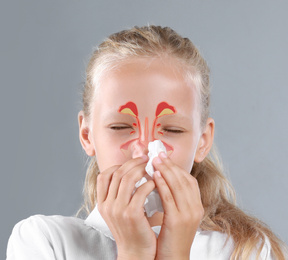 Image of Little girl suffering from runny nose as allergy symptom. Sinuses illustration on face