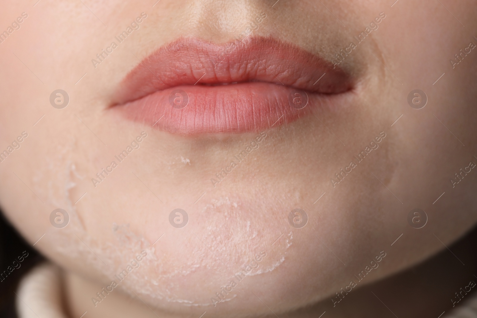 Photo of Closeup view of woman with dry skin