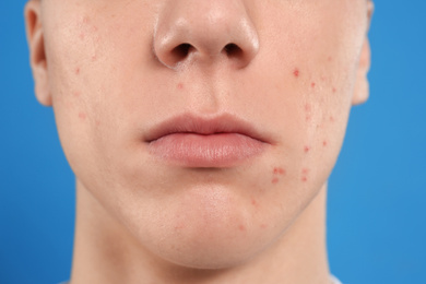 Photo of Teen guy with acne problem on blue background, closeup