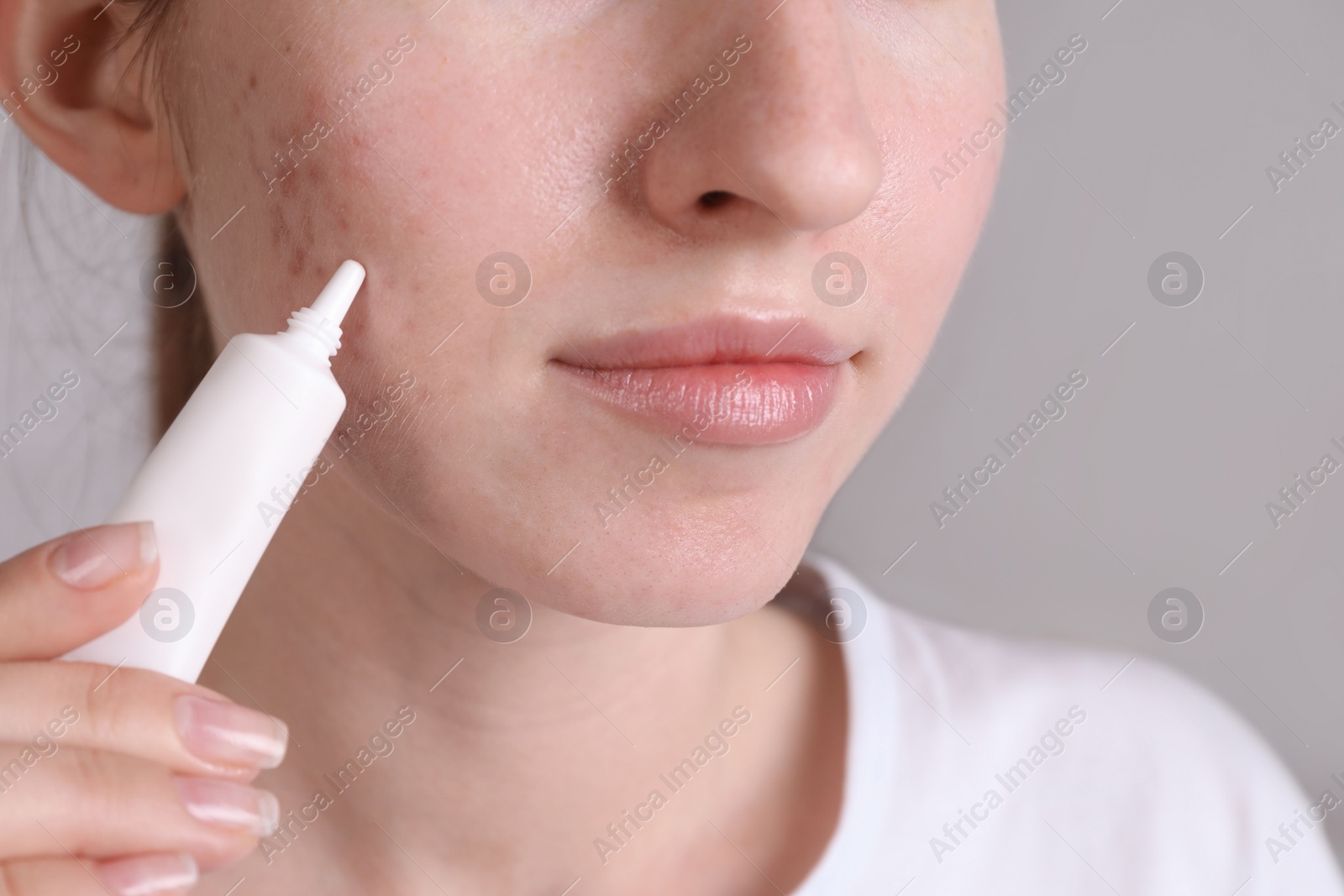 Photo of Woman with acne problem applying cream at home, closeup