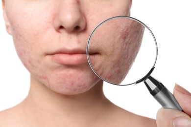 Dermatologist looking at woman's face with magnifying glass on white background, closeup. Zoomed view on acne