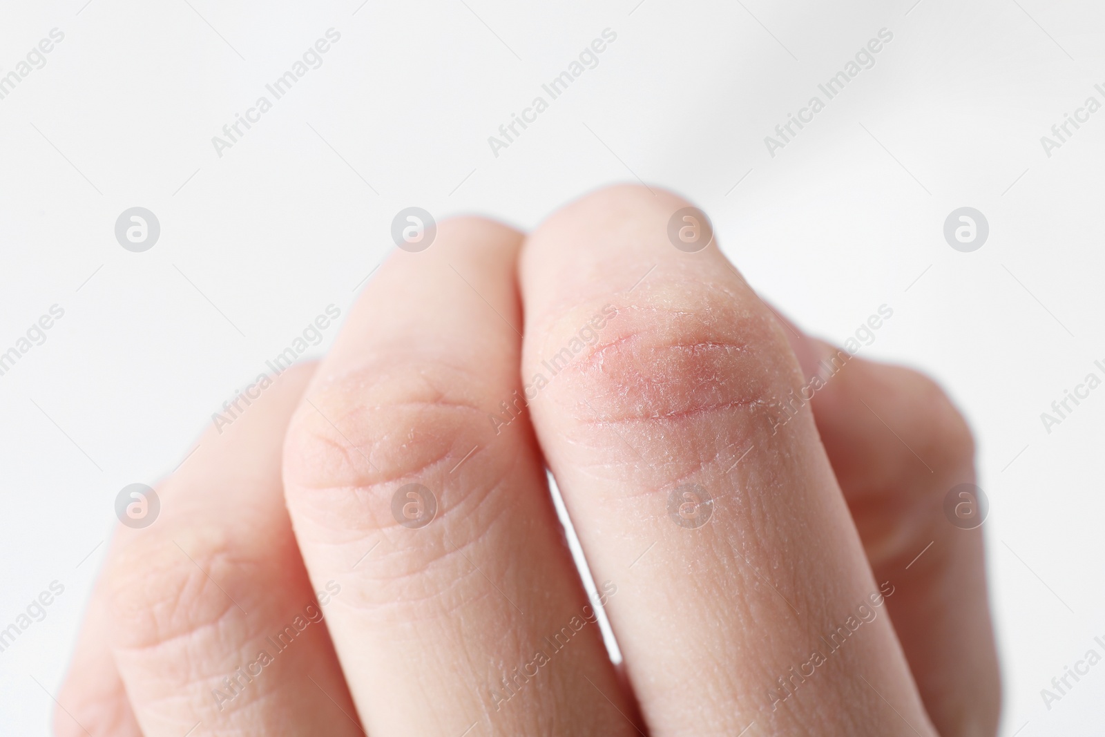 Photo of Woman with dry skin on fingers against light background, closeup