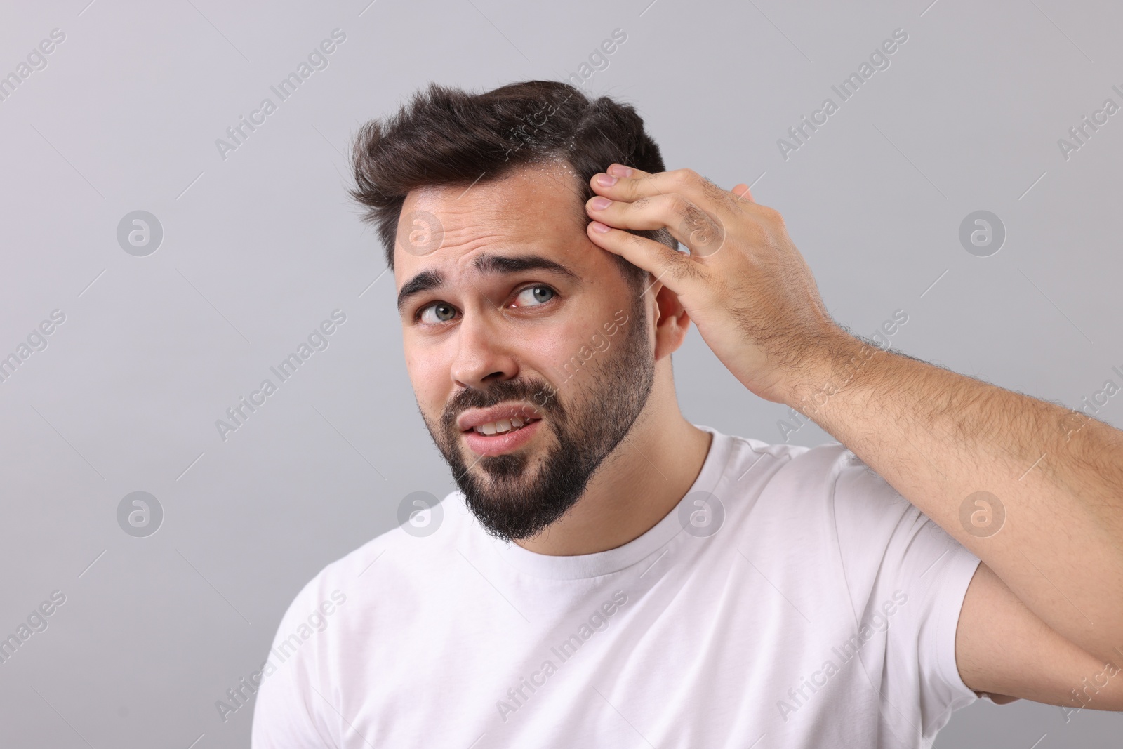 Photo of Emotional man with dandruff in his dark hair on light grey background