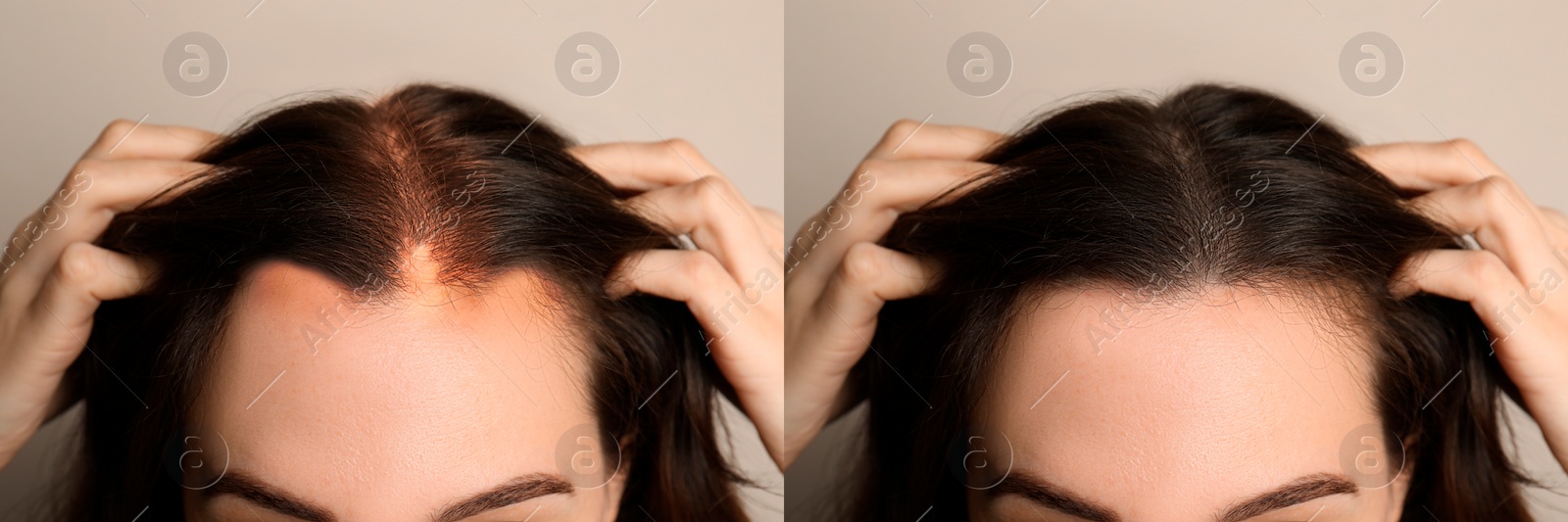 Image of Woman before and after hair treatment with high frequency darsonval device on beige background, closeup. Collage of photos