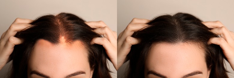 Woman before and after hair treatment with high frequency darsonval device on beige background, closeup. Collage of photos