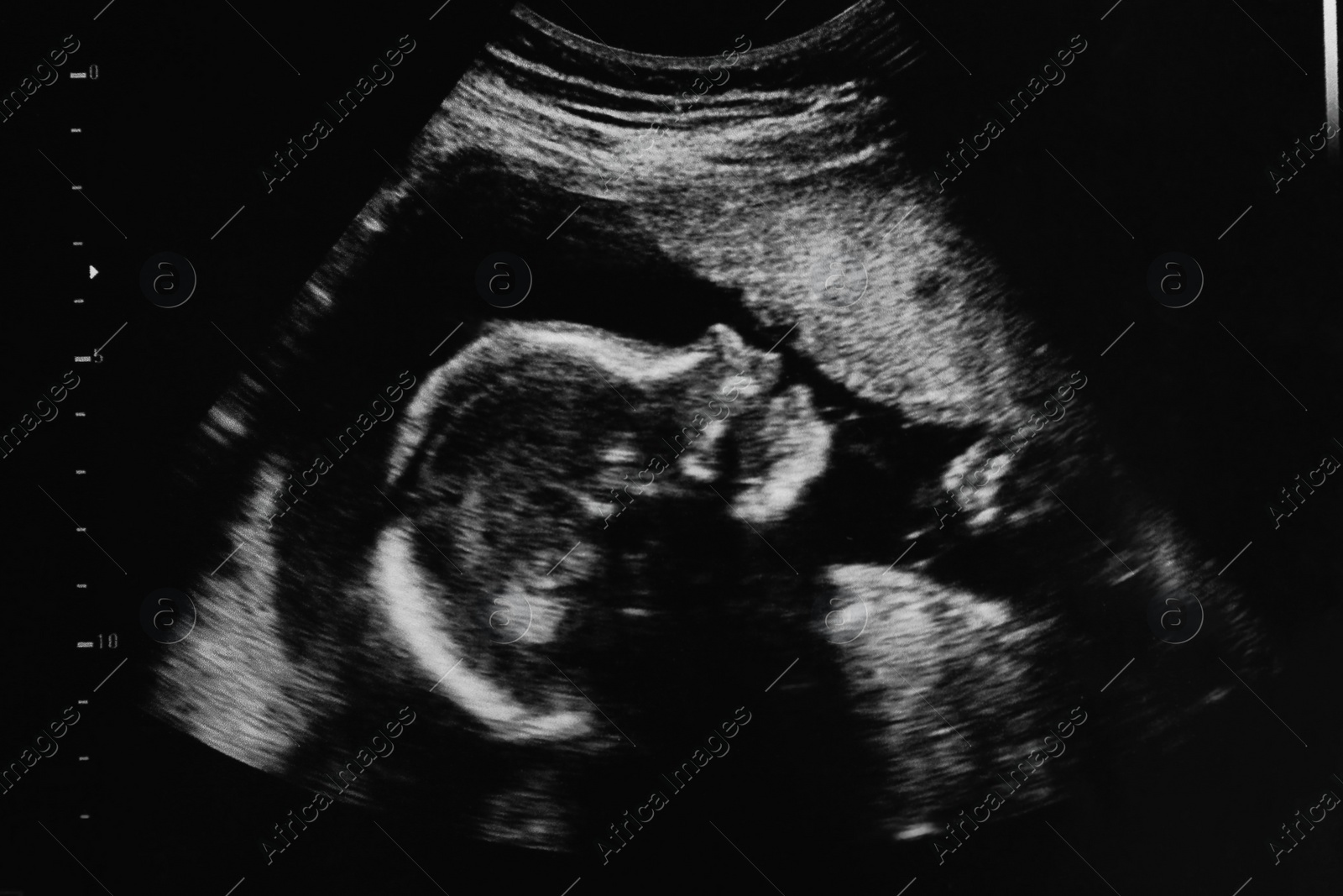 Photo of Ultrasound photo of unborn baby in mother's womb, closeup view