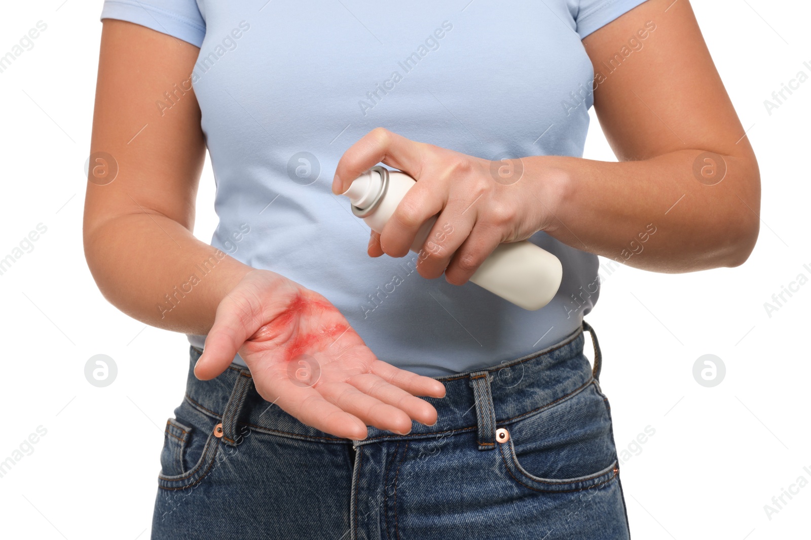 Photo of Woman applying panthenol onto burned hand on white background, closeup